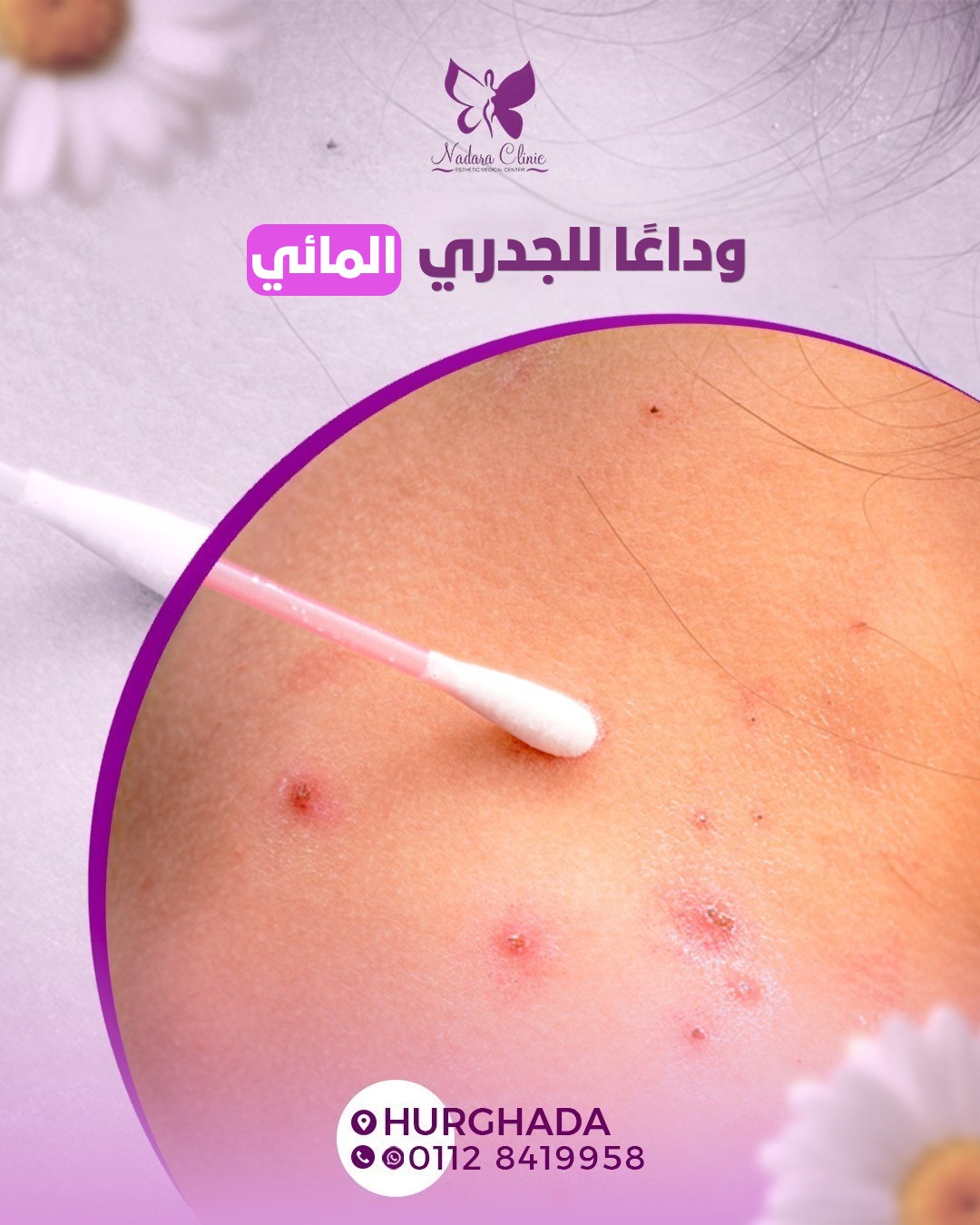 وداعًا للجدري المائي في الغردقة